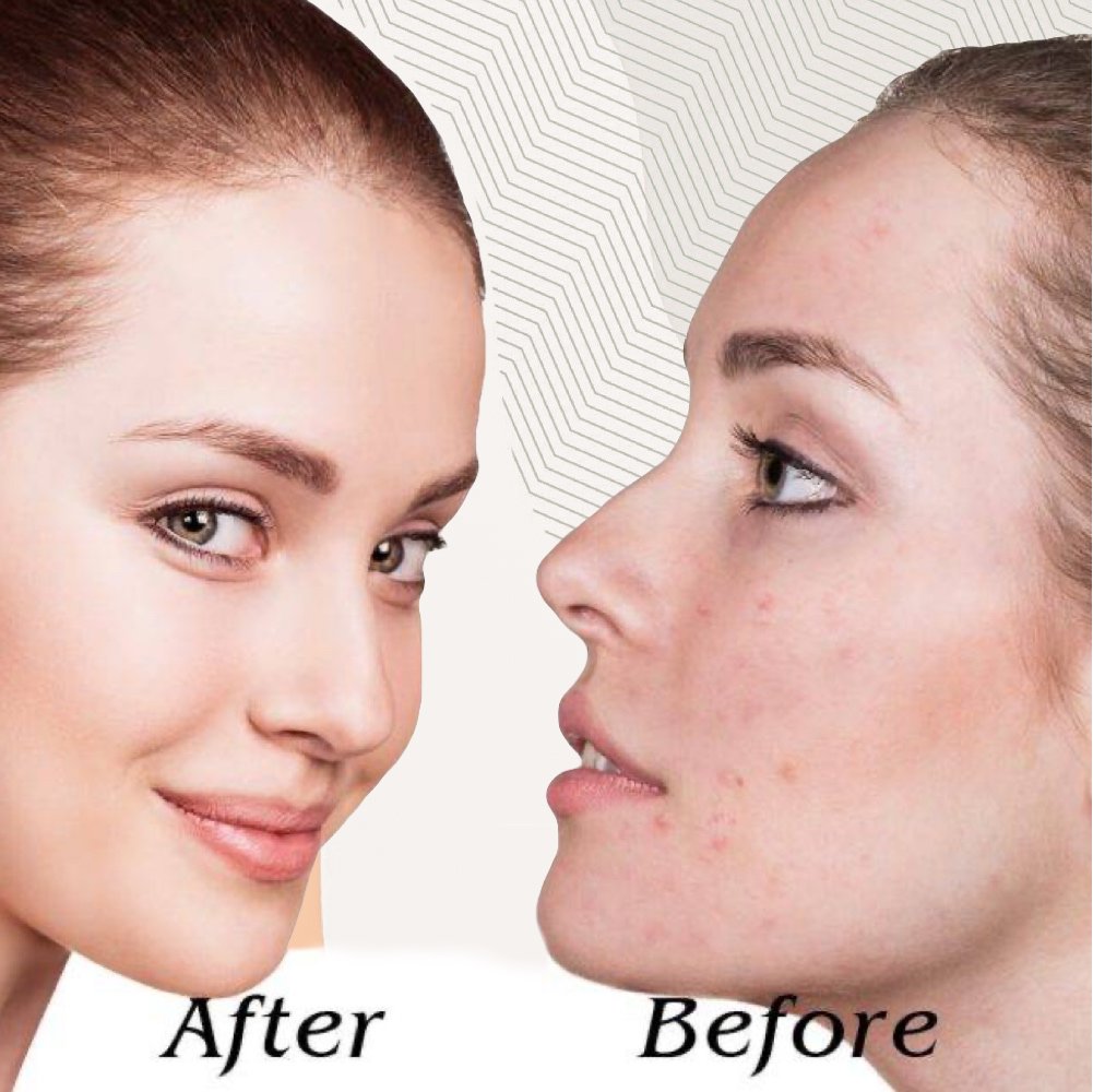 Black Head Remover