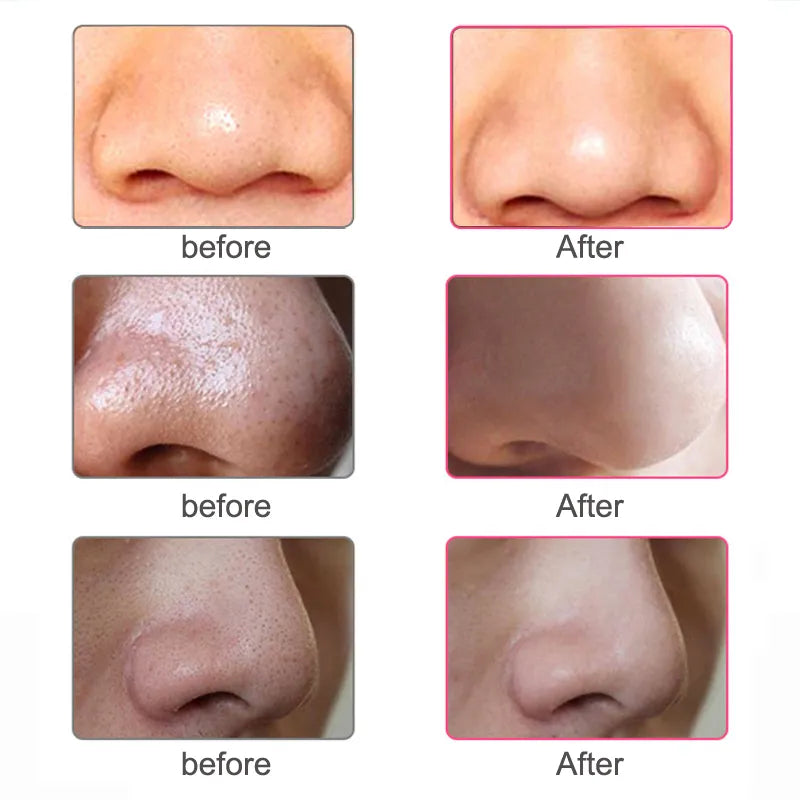 Black Head Remover